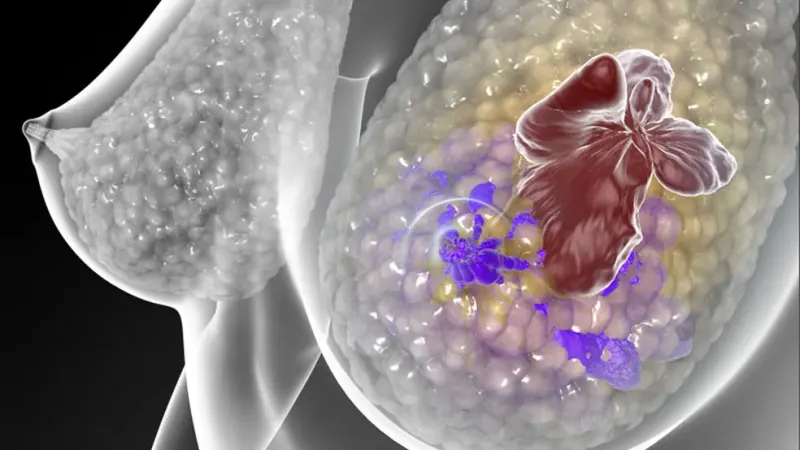 Inca Study Uses Technology to Predict Breast Cancer Risk